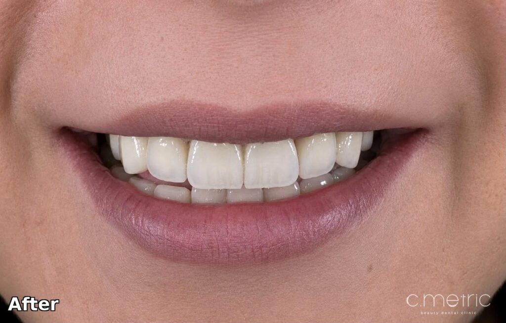 After: anterior porcelain crowns from canine to canine. C.Metric, Dbayeh