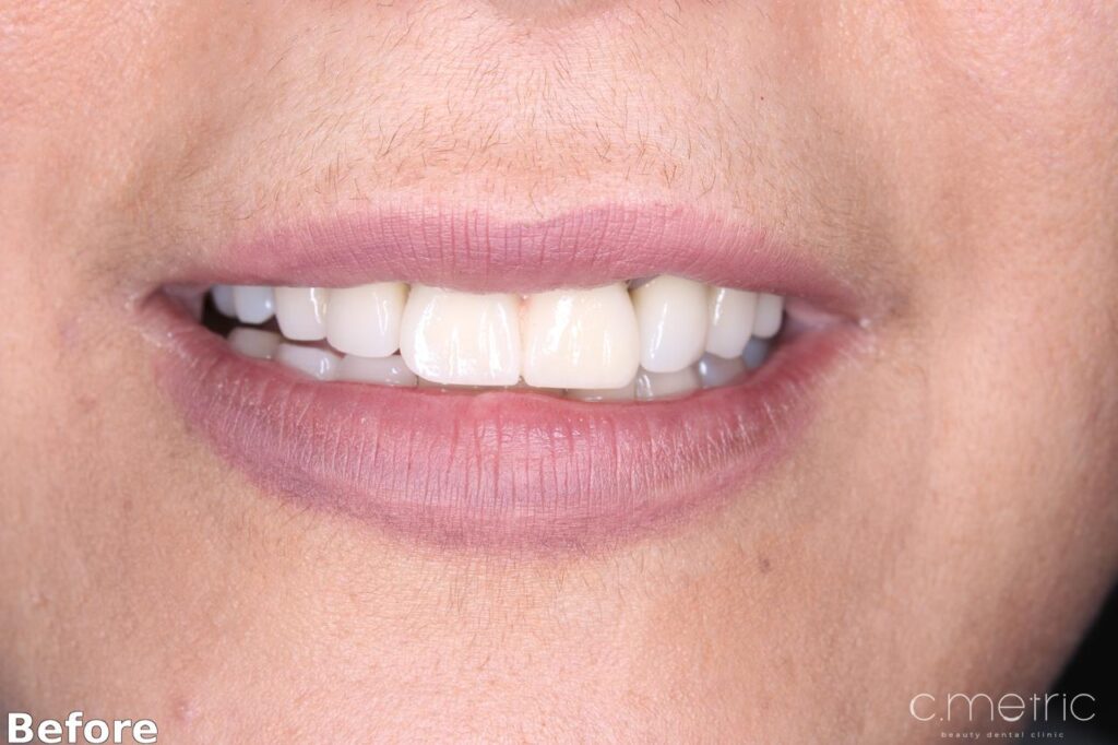 Before: worn, uneven front teeth, anterior crowns case at C.Metric, Dbayeh