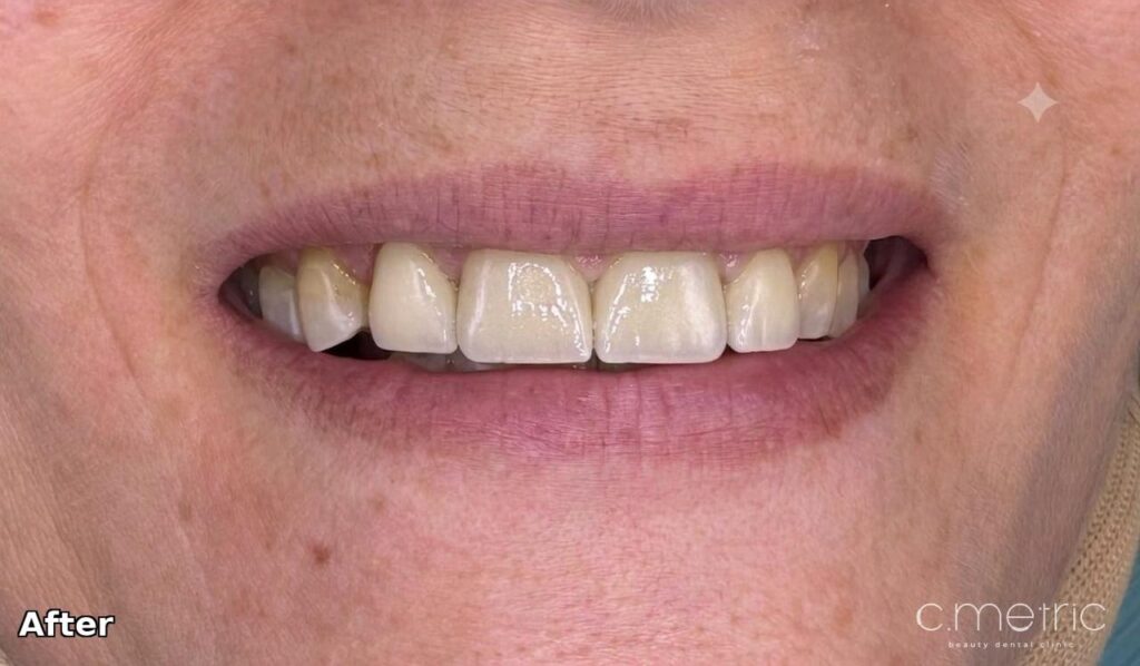 After: zirconia crowns closing the gap, natural smile. C.Metric, Dbayeh