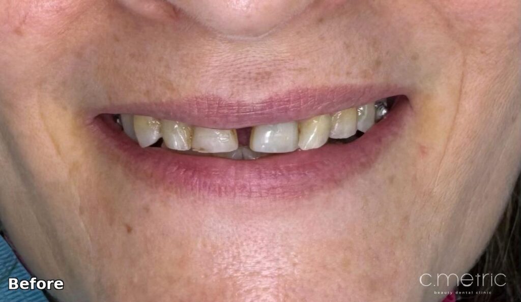 Before: midline gap and missing canine. C.Metric, Dbayeh