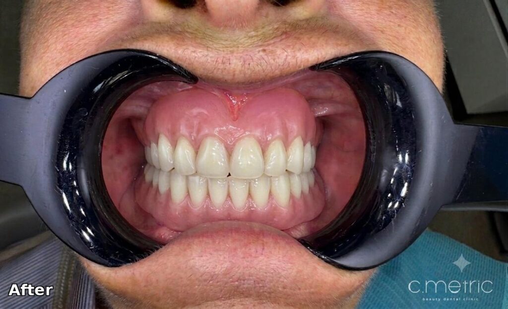 After: complete denture full-arch rehabilitation. C.Metric, Dbayeh