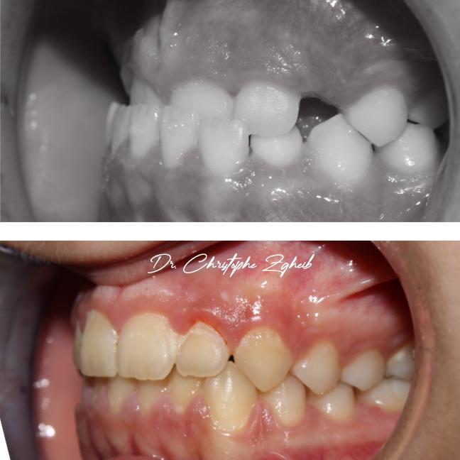 Orthodontics Before & After — Dr. Christophe Zgheib Orthodontic before and after results by Dr. Christophe Zgheib, orthodontist at C.Metric in Dbayeh, Lebanon
