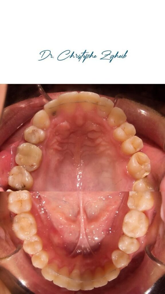 Orthodontics Before & After — Dr. Christophe Zgheib Smile transformation before and after braces by Dr. Christophe Zgheib at C.Metric clinic, Dbayeh