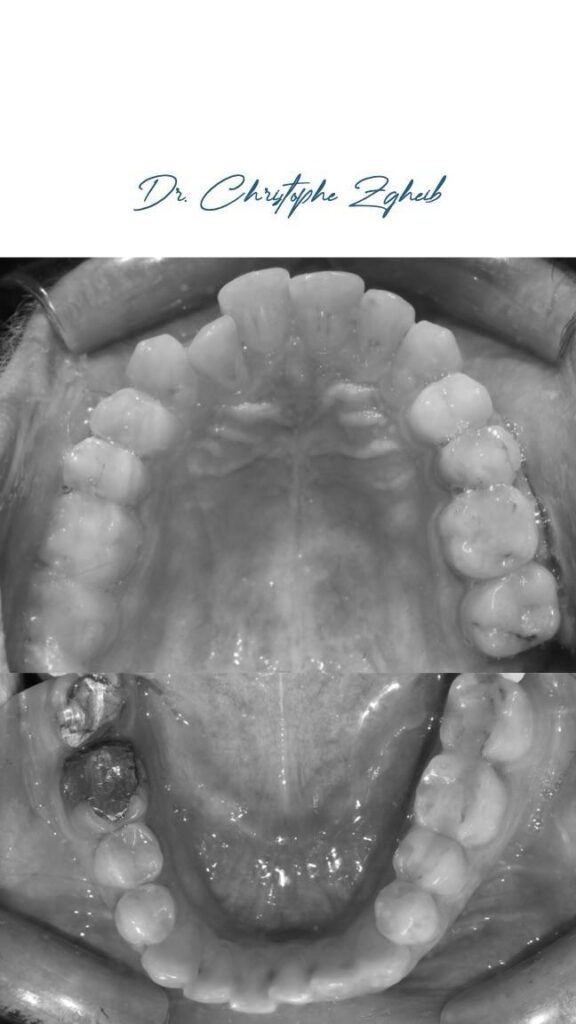 Orthodontics Before & After — Dr. Christophe Zgheib Dental arch alignment before and after orthodontic treatment at C.Metric, Dbayeh, Lebanon