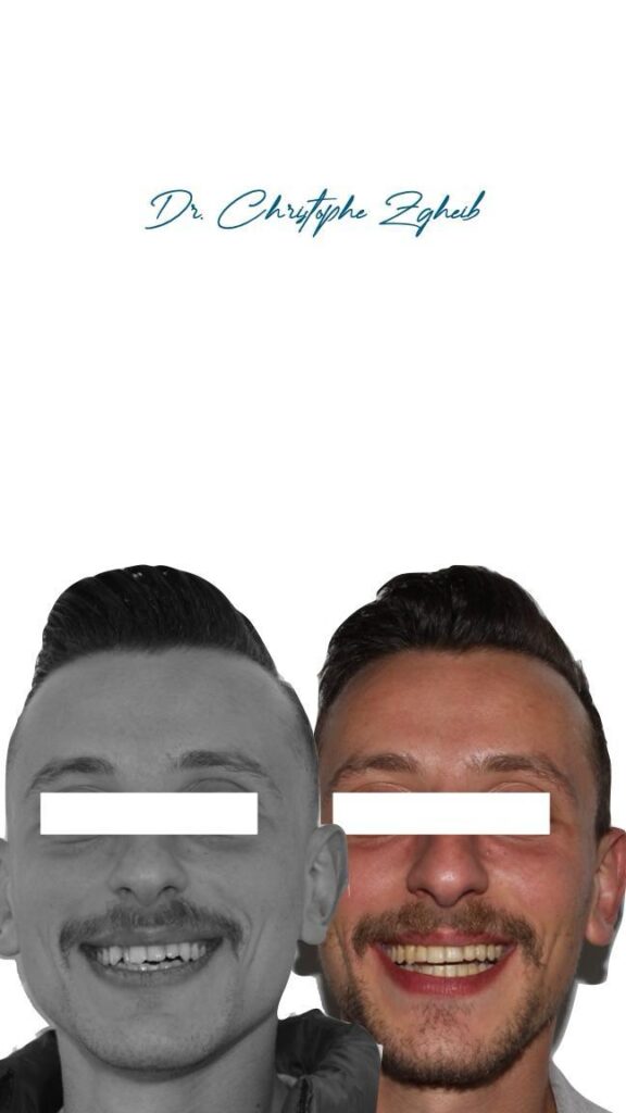 Orthodontics Before & After — Dr. Christophe Zgheib Bite correction and teeth alignment before and after orthodontics by Dr. Christophe Zgheib in Dbayeh