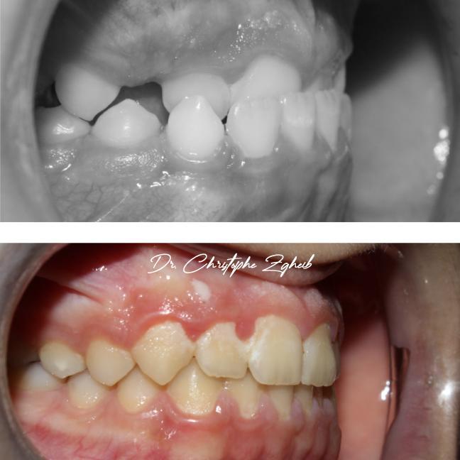 Orthodontics Before & After — Dr. Christophe Zgheib Orthodontic before and after results by Dr. Christophe Zgheib, orthodontist at C.Metric in Dbayeh, Lebanon