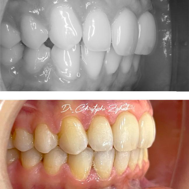 Orthodontics Before & After — Dr. Christophe Zgheib Crowded, misaligned teeth straightened with orthodontic treatment at C.Metric in Dbayeh, before and after