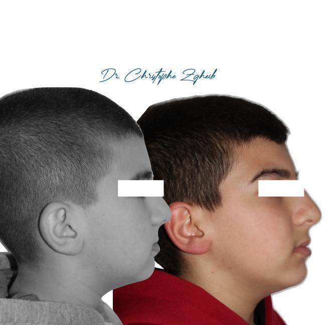 Orthodontics Before & After — Dr. Christophe Zgheib Smile transformation before and after braces by Dr. Christophe Zgheib at C.Metric clinic, Dbayeh