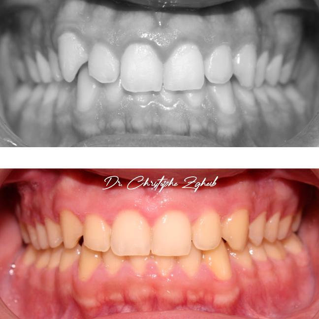 Orthodontics Before & After — Dr. Christophe Zgheib Dental arch alignment before and after orthodontic treatment at C.Metric, Dbayeh, Lebanon