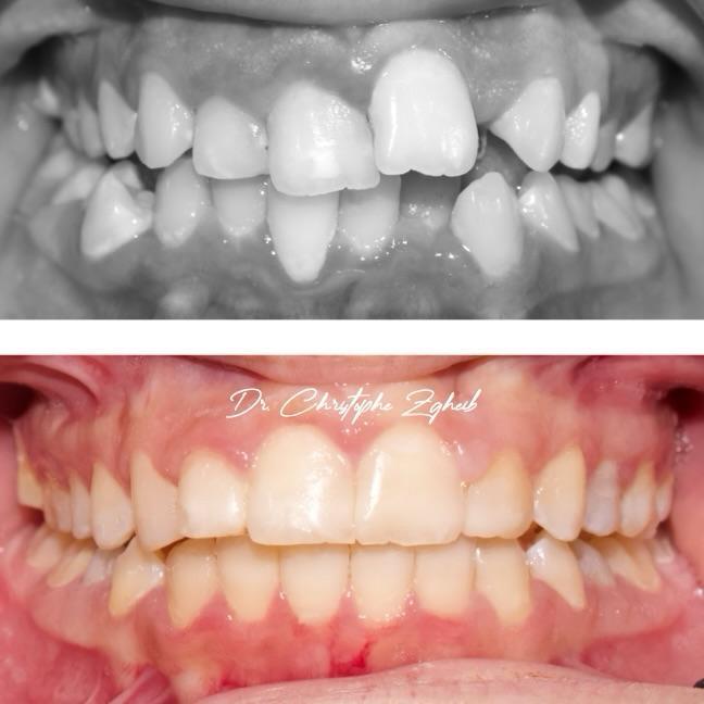 Orthodontics Before & After — Dr. Christophe Zgheib Bite correction and teeth alignment before and after orthodontics by Dr. Christophe Zgheib in Dbayeh