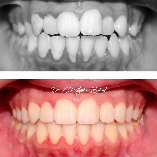 Orthodontics Before & After — Dr. Christophe Zgheib Orthodontic before and after results by Dr. Christophe Zgheib, orthodontist at C.Metric in Dbayeh, Lebanon
