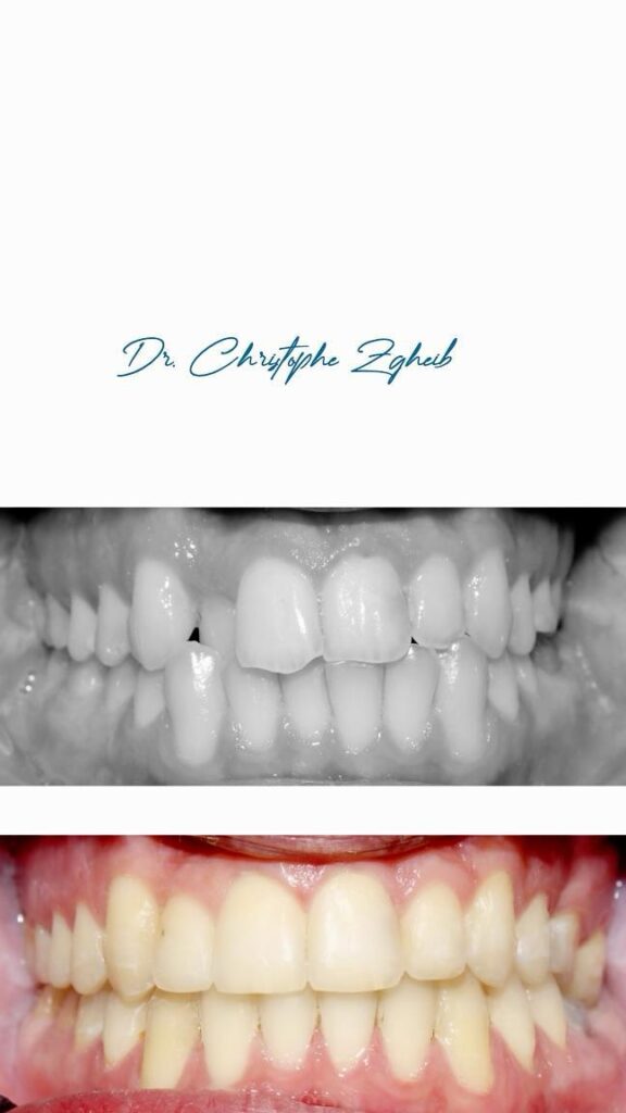 Orthodontics Before & After — Dr. Christophe Zgheib Smile transformation before and after braces by Dr. Christophe Zgheib at C.Metric clinic, Dbayeh