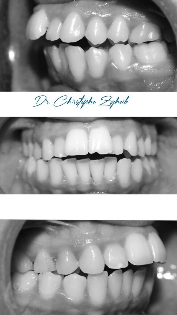 Orthodontics Before & After — Dr. Christophe Zgheib Dental arch alignment before and after orthodontic treatment at C.Metric, Dbayeh, Lebanon