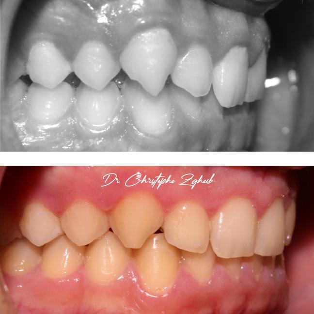Orthodontics Before & After — Dr. Christophe Zgheib Orthodontic before and after results by Dr. Christophe Zgheib, orthodontist at C.Metric in Dbayeh, Lebanon