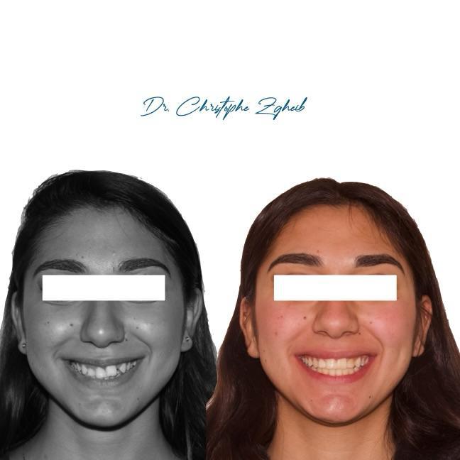 Orthodontics Before & After — Dr. Christophe Zgheib Crowded, misaligned teeth straightened with orthodontic treatment at C.Metric in Dbayeh, before and after
