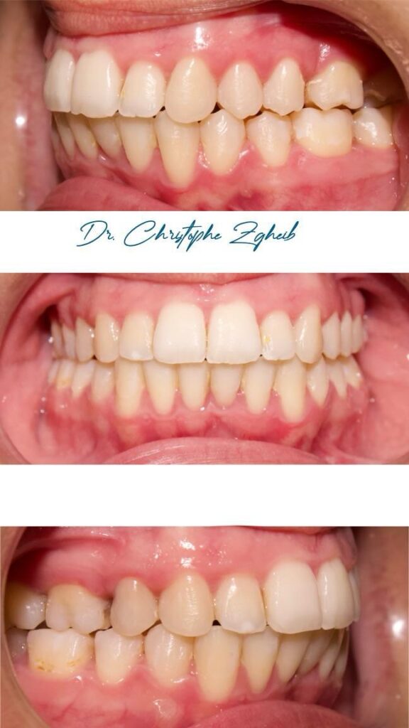 Orthodontics Before & After — Dr. Christophe Zgheib Dental arch alignment before and after orthodontic treatment at C.Metric, Dbayeh, Lebanon