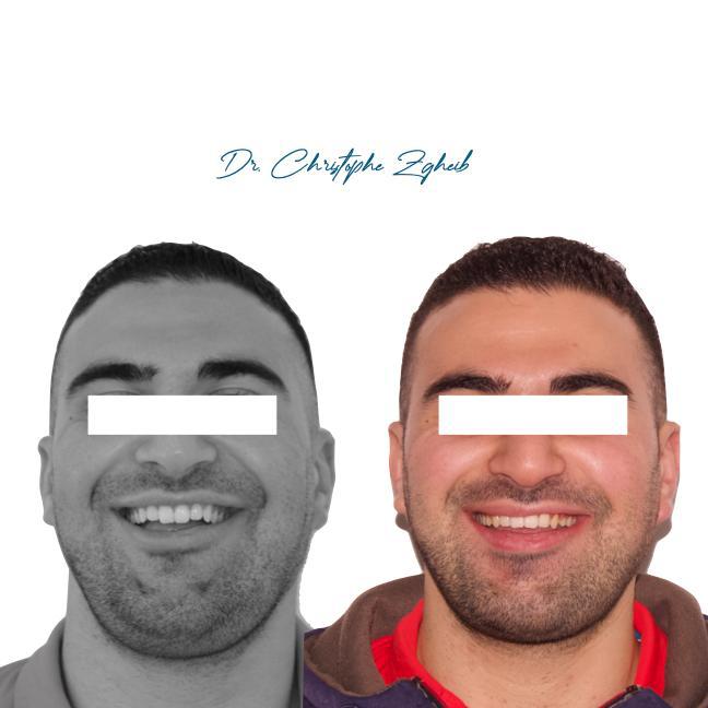 Orthodontics Before & After — Dr. Christophe Zgheib Bite correction and teeth alignment before and after orthodontics by Dr. Christophe Zgheib in Dbayeh