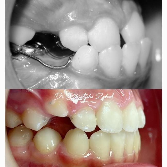 Orthodontics Before & After — Dr. Christophe Zgheib Orthodontic before and after results by Dr. Christophe Zgheib, orthodontist at C.Metric in Dbayeh, Lebanon