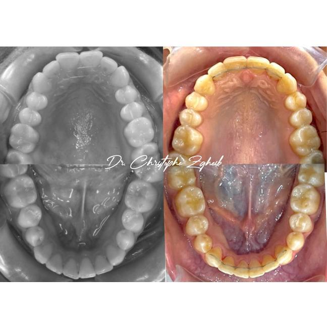Orthodontics Before & After — Dr. Christophe Zgheib Crowded, misaligned teeth straightened with orthodontic treatment at C.Metric in Dbayeh, before and after