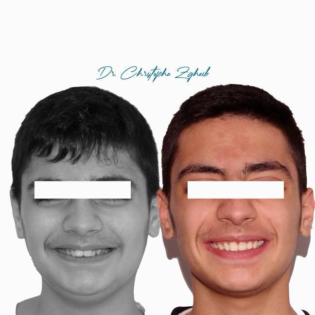 Orthodontics Before & After — Dr. Christophe Zgheib Smile transformation before and after braces by Dr. Christophe Zgheib at C.Metric clinic, Dbayeh