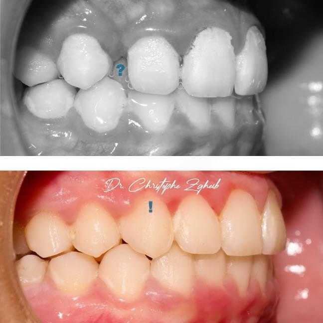 Orthodontics Before & After — Dr. Christophe Zgheib Dental arch alignment before and after orthodontic treatment at C.Metric, Dbayeh, Lebanon