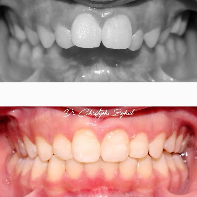 Orthodontics Before & After — Dr. Christophe Zgheib Bite correction and teeth alignment before and after orthodontics by Dr. Christophe Zgheib in Dbayeh