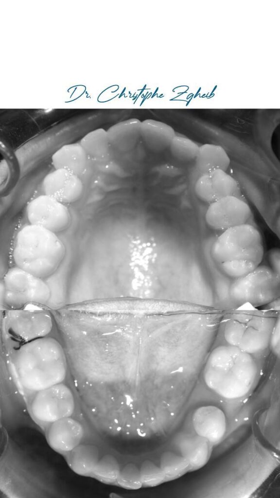 Orthodontics Before & After — Dr. Christophe Zgheib Crowded, misaligned teeth straightened with orthodontic treatment at C.Metric in Dbayeh, before and after
