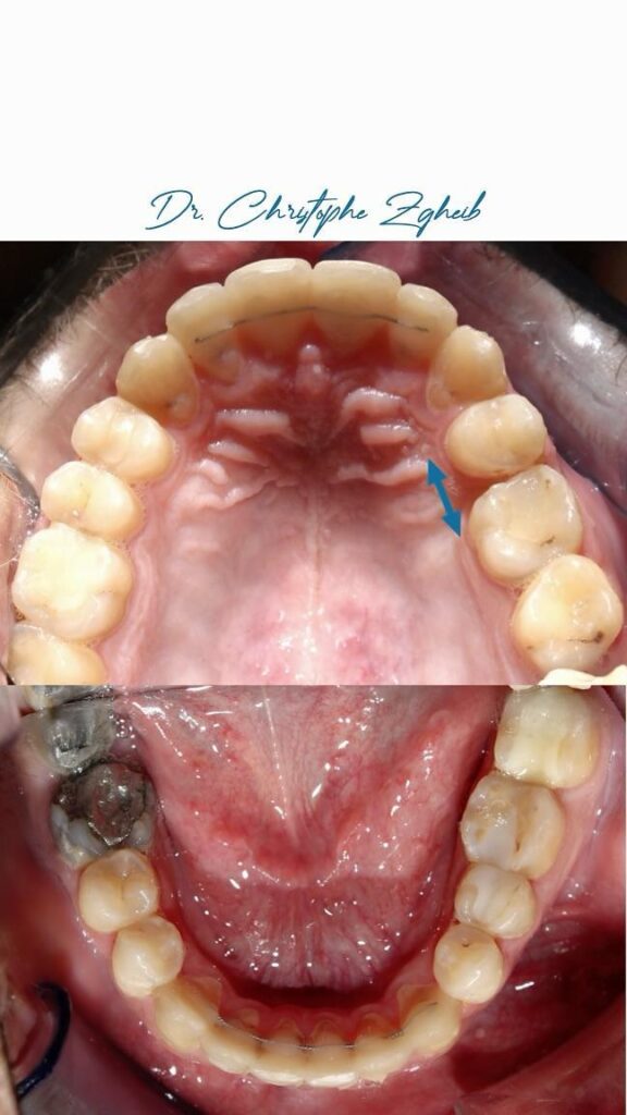 Orthodontics Before & After — Dr. Christophe Zgheib Smile transformation before and after braces by Dr. Christophe Zgheib at C.Metric clinic, Dbayeh