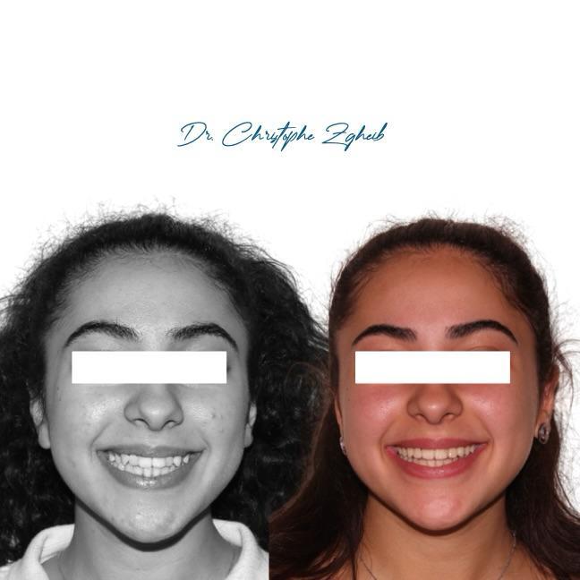 Orthodontics Before & After — Dr. Christophe Zgheib Dental arch alignment before and after orthodontic treatment at C.Metric, Dbayeh, Lebanon