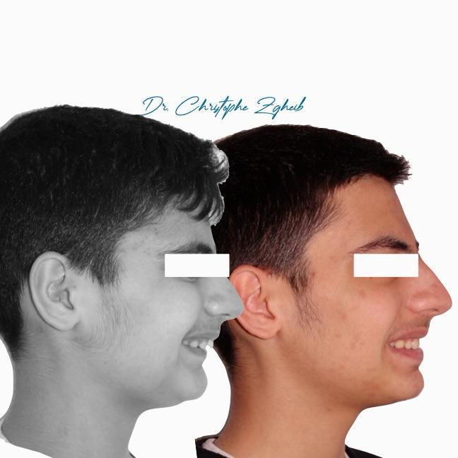 Orthodontics Before & After — Dr. Christophe Zgheib Bite correction and teeth alignment before and after orthodontics by Dr. Christophe Zgheib in Dbayeh