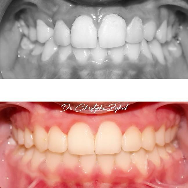 Orthodontics Before & After — Dr. Christophe Zgheib Orthodontic before and after results by Dr. Christophe Zgheib, orthodontist at C.Metric in Dbayeh, Lebanon