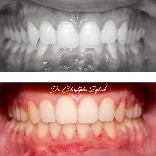 Orthodontics Before & After — Dr. Christophe Zgheib Crowded, misaligned teeth straightened with orthodontic treatment at C.Metric in Dbayeh, before and after