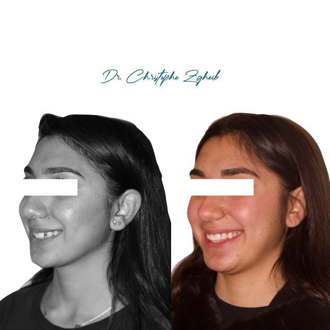 Orthodontics Before & After — Dr. Christophe Zgheib Smile transformation before and after braces by Dr. Christophe Zgheib at C.Metric clinic, Dbayeh