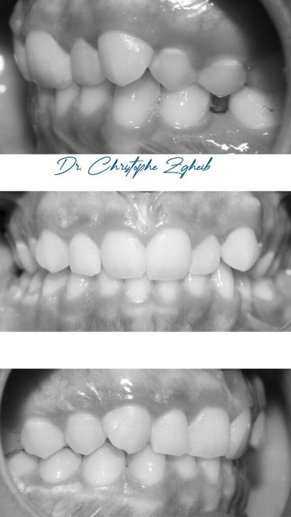 Orthodontics Before & After — Dr. Christophe Zgheib Dental arch alignment before and after orthodontic treatment at C.Metric, Dbayeh, Lebanon