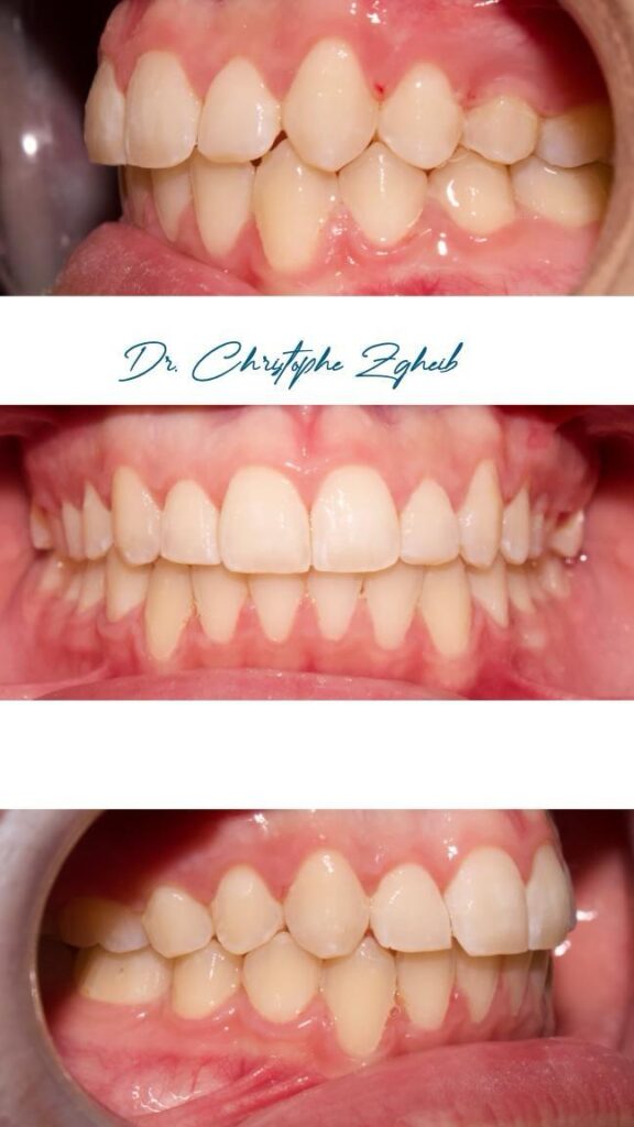 Orthodontics Before & After — Dr. Christophe Zgheib Bite correction and teeth alignment before and after orthodontics by Dr. Christophe Zgheib in Dbayeh