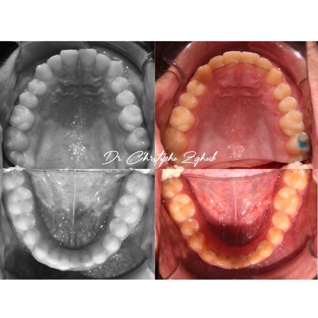 Orthodontics Before & After — Dr. Christophe Zgheib Orthodontic before and after results by Dr. Christophe Zgheib, orthodontist at C.Metric in Dbayeh, Lebanon