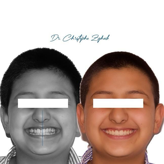 Orthodontics Before & After — Dr. Christophe Zgheib Crowded, misaligned teeth straightened with orthodontic treatment at C.Metric in Dbayeh, before and after