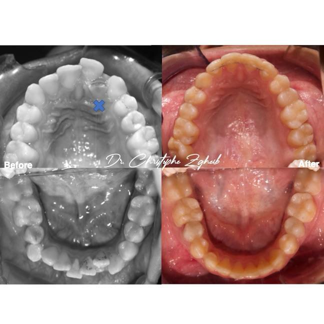 Orthodontics Before & After — Dr. Christophe Zgheib Smile transformation before and after braces by Dr. Christophe Zgheib at C.Metric clinic, Dbayeh