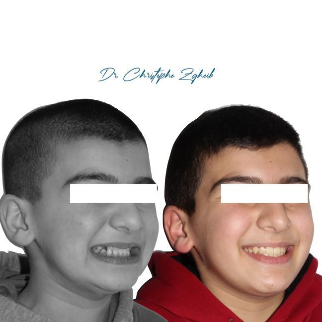 Orthodontics Before & After — Dr. Christophe Zgheib Dental arch alignment before and after orthodontic treatment at C.Metric, Dbayeh, Lebanon