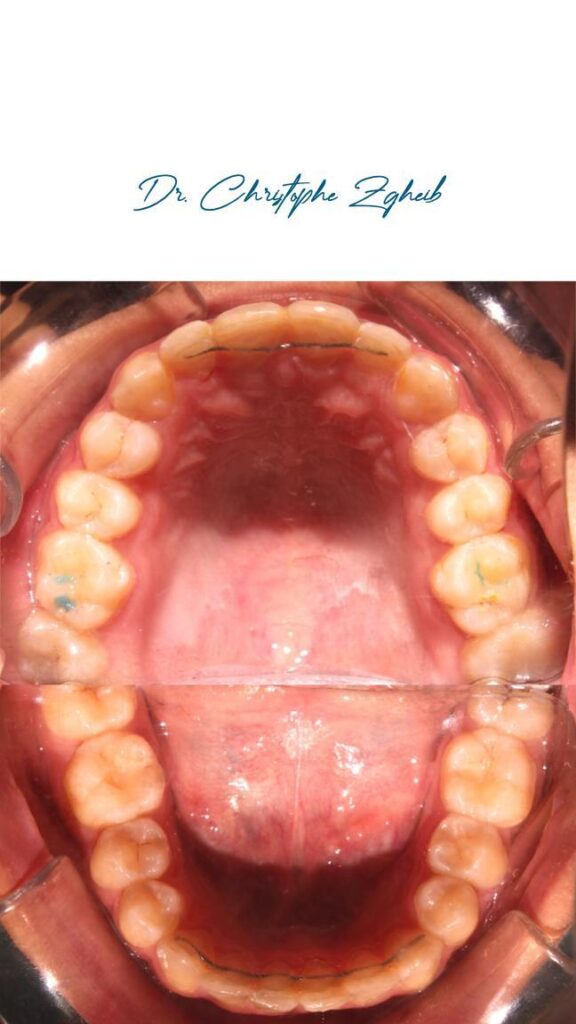Orthodontics Before & After — Dr. Christophe Zgheib Bite correction and teeth alignment before and after orthodontics by Dr. Christophe Zgheib in Dbayeh