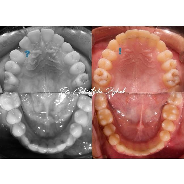 Orthodontics Before & After — Dr. Christophe Zgheib Orthodontic before and after results by Dr. Christophe Zgheib, orthodontist at C.Metric in Dbayeh, Lebanon